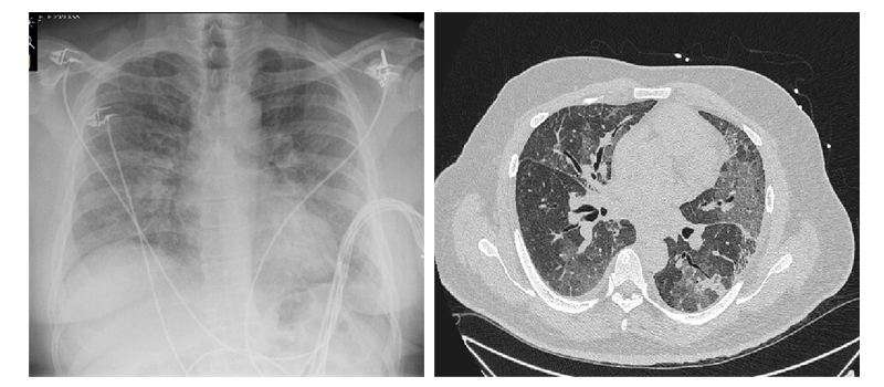 a-60-year-old-male-presents-with-shortness-of-breath-and-leg-swelling